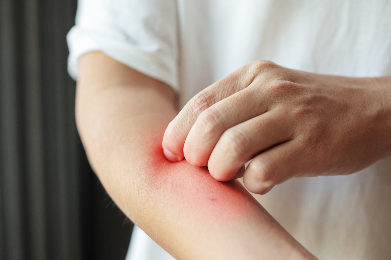 ghk-cu eczema or atopic dermatitis Chapter 2: Understanding Eczema: Symptoms, Triggers, and