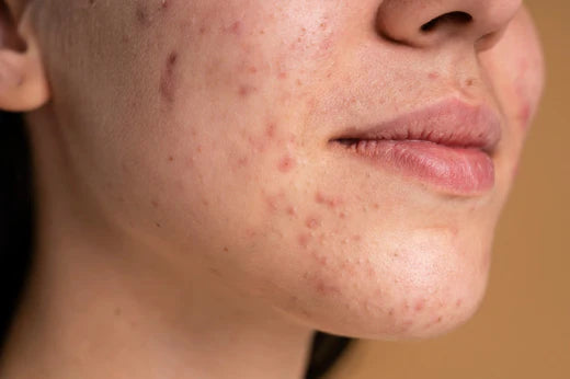 Black spots on discount skin