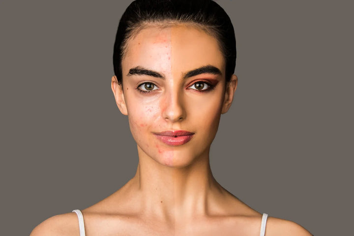 women face having acne | acne cream