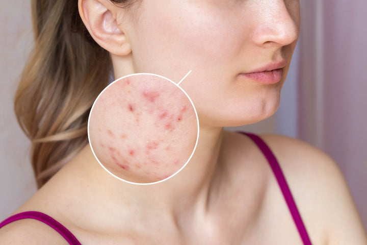 a woman with infected pimples