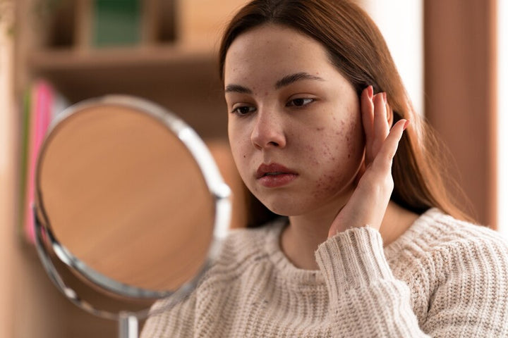 Acne Vulgaris- Cause, Sysmtorms & Treatment