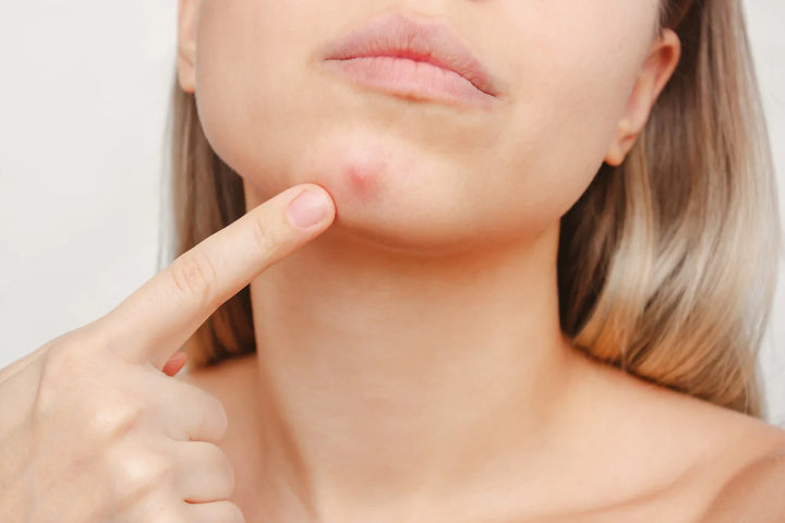 A woman pointing at her pimple | breakouts on face