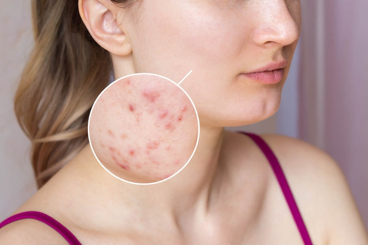 Check Out These Warning Signs of Over Exfoliated Skin – Saturn by GHC