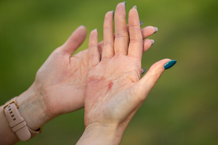 Heat Rash On Hands