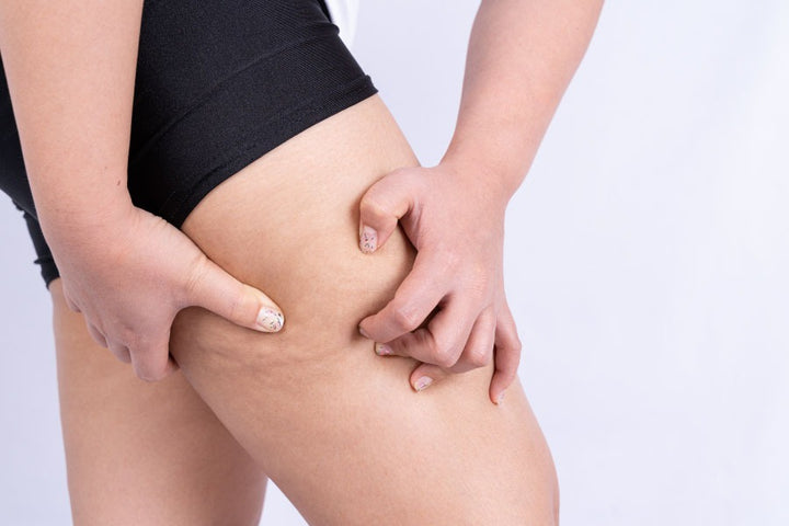 Home Remedies to Cure Rashes Due to Thigh Chafing – Saturn by GHC