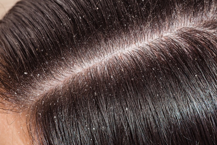 a scalp of women filled with dandruff | How to Prevent Dandruff in Summer