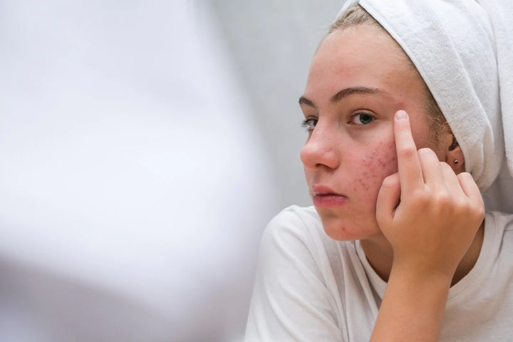 Acne and pimples | Reasons for Blood-Filled Pimple on Face