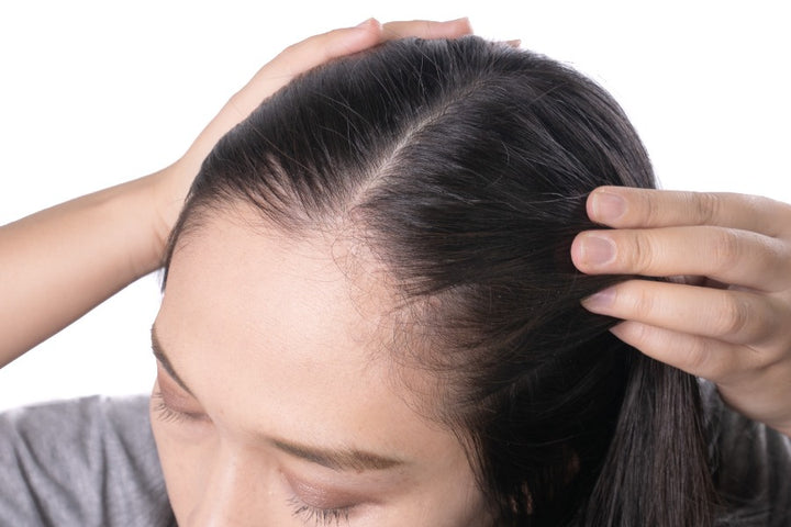 a woman showing acne on her scalp