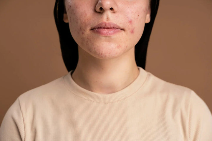 Woman with hyperpigmentation | hyperpigmentation around mouth