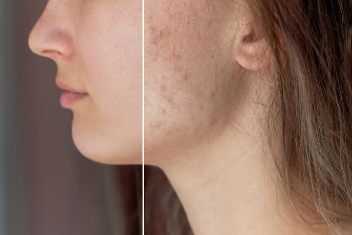 woman face before and after acne treatment | What will Happen if I Leave Acne Cream on Overnight