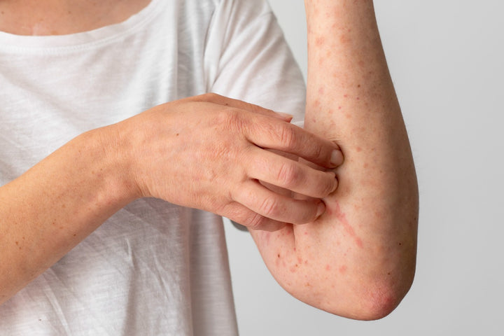 a woman suffering from eczema