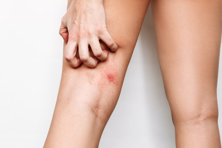 Causes, Symptoms & Treatment of Thigh Chafing – Saturn by GHC