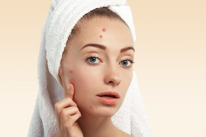 a woman who is suffering from severe breakouts