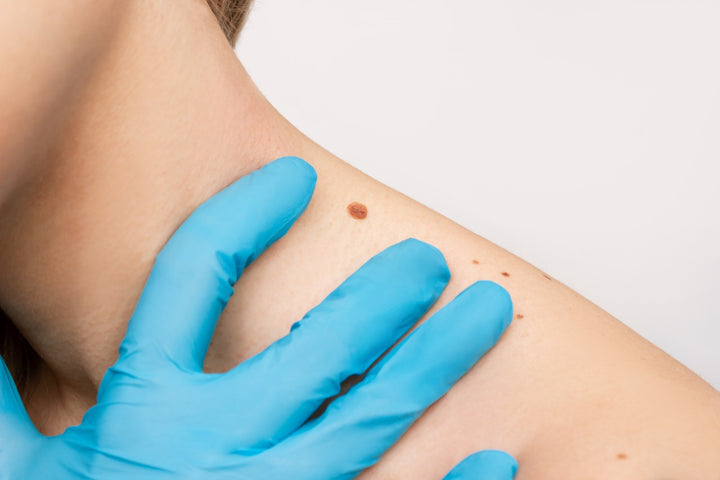 Pockmark Definition Effective Ways to Get Rid of Pockmarks – Saturn by GHC
