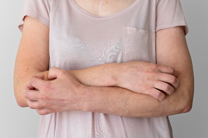 a woman suffering from bacterial skin rash