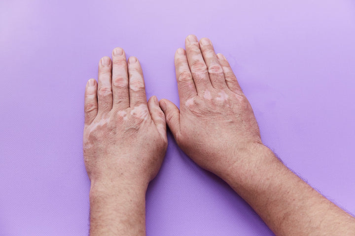 hands showing vitiligo problem