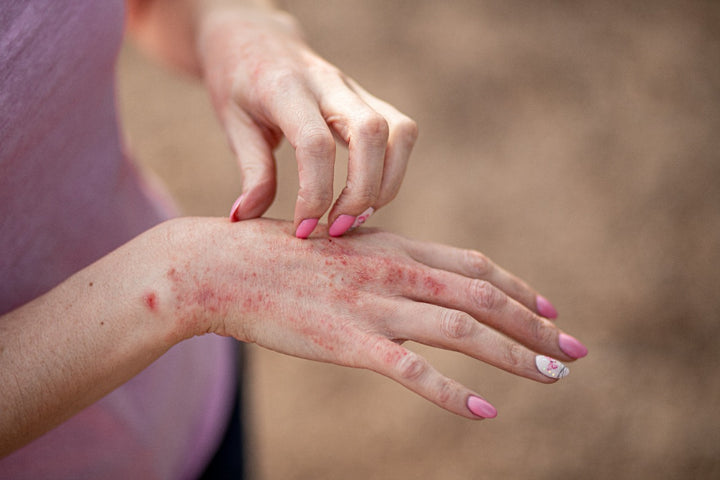 a woman suffering from heat rashes on her hands
