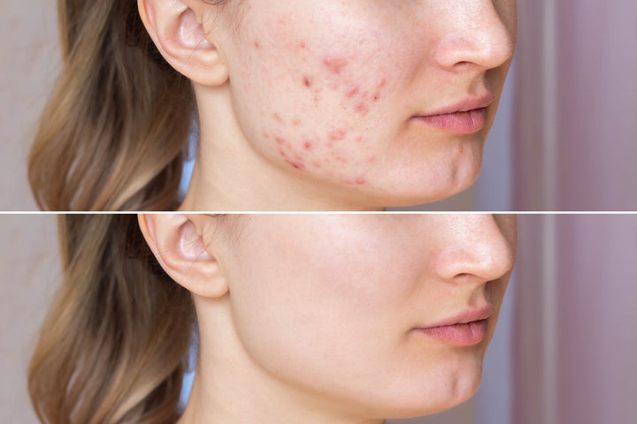 woman's face before and after acne scars treatment